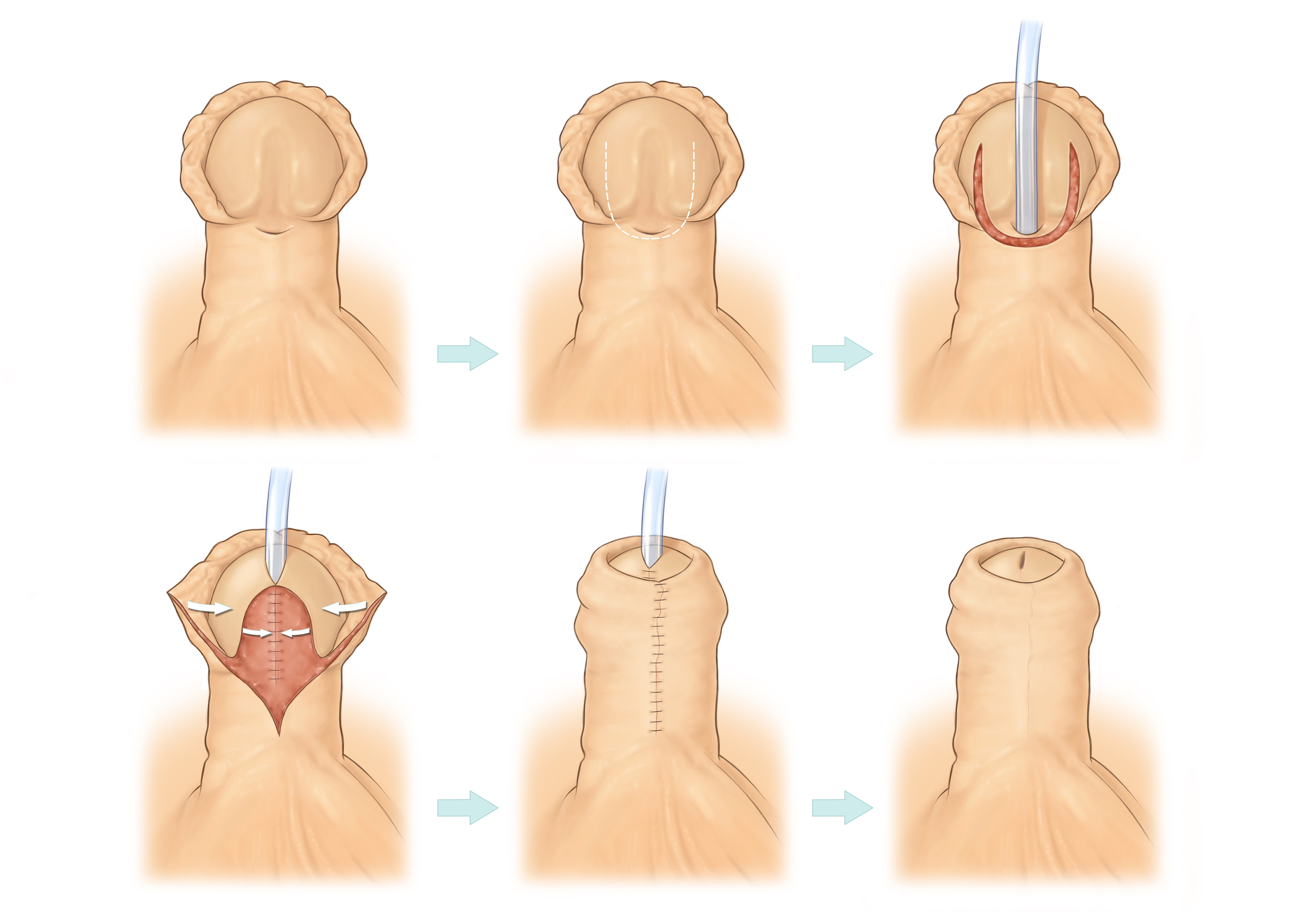 best hypospadias surgeon in thane